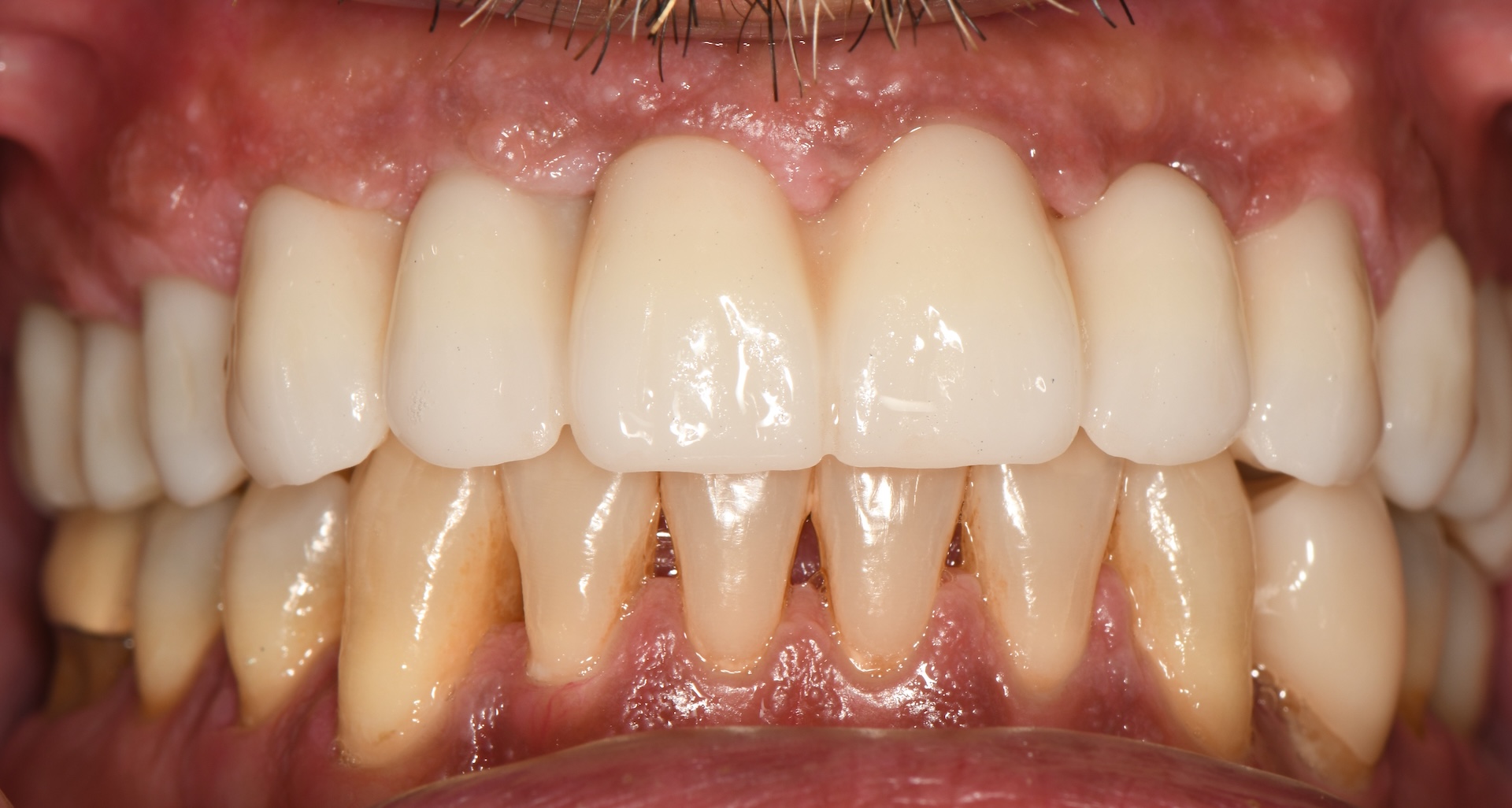 Natural-looking smile with full-arch restoration