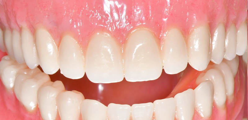 Full-arch smile with natural tooth arrangement