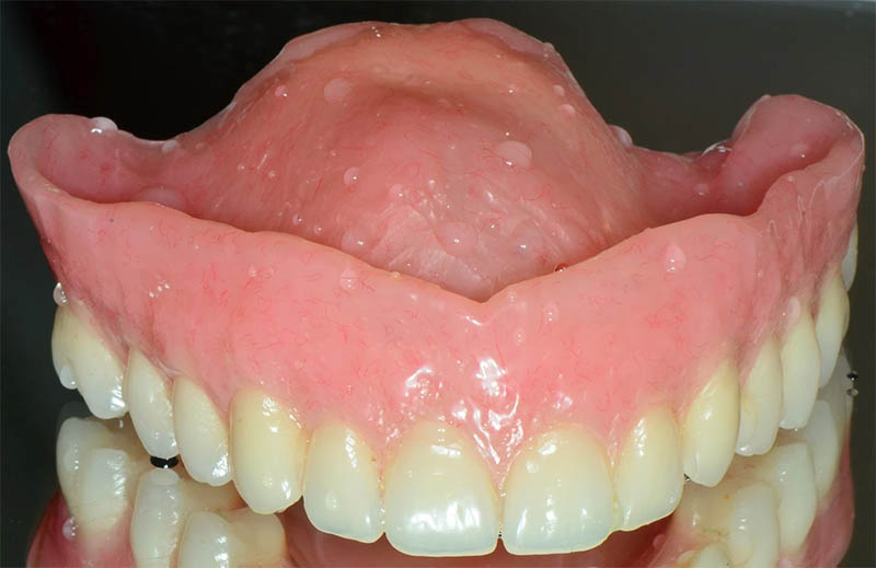 Finished complete denture with lifelike esthetics