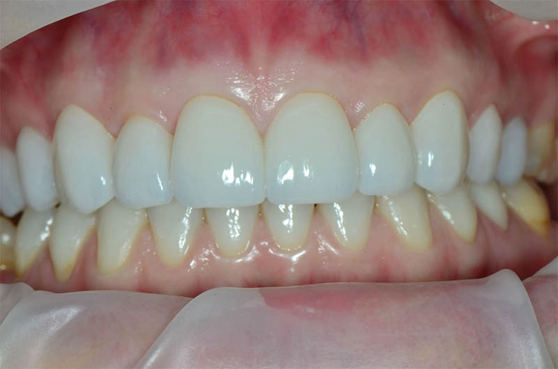 Refined, lifelike smile restoration by Dr. Salloum