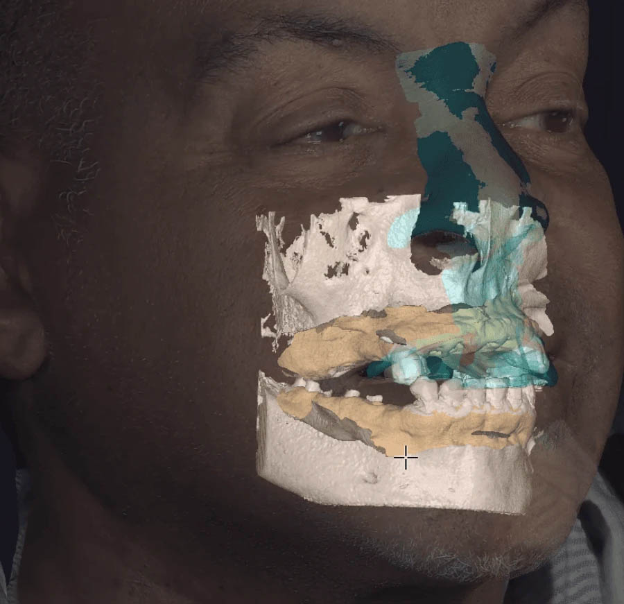 Hybrid intraoral–extraoral scan data superimposed on a patient's face