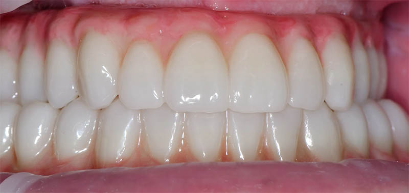 Completed full-arch implant-supported restoration