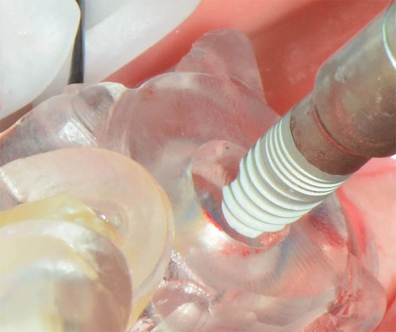 Implant being placed through a clear static surgical guide